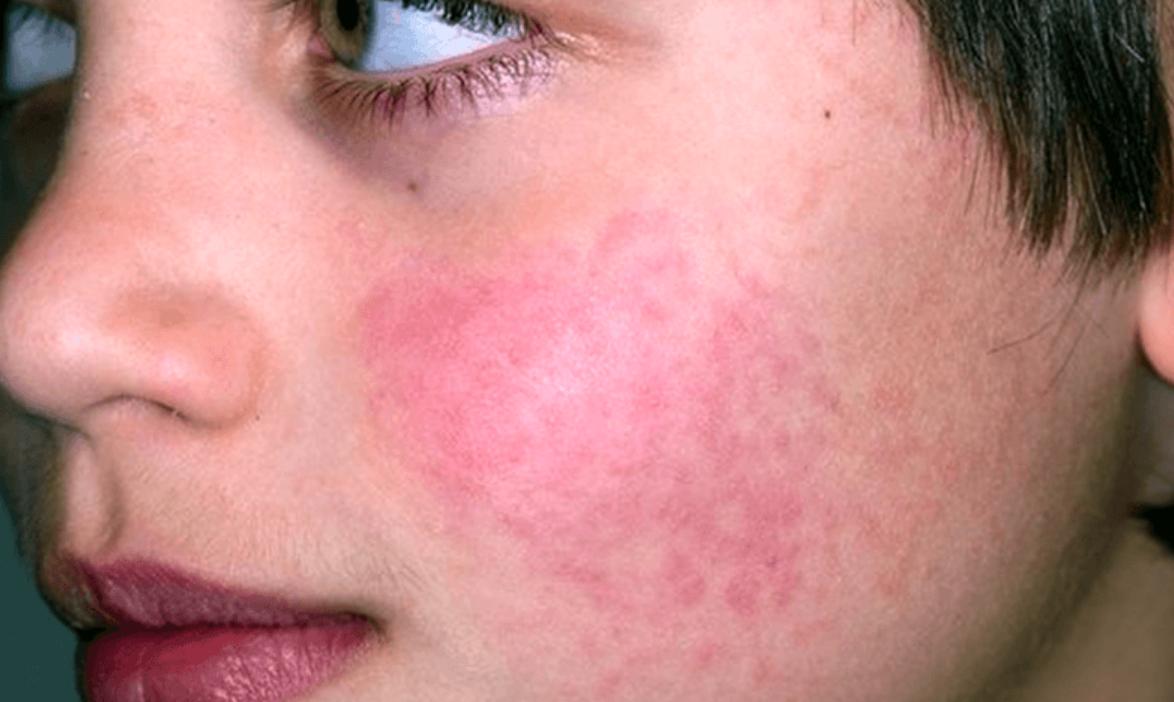 биоревитализация лица - возможна аллергия