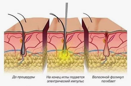 Электроэпиляция: попрощаться с нежелательными волосами