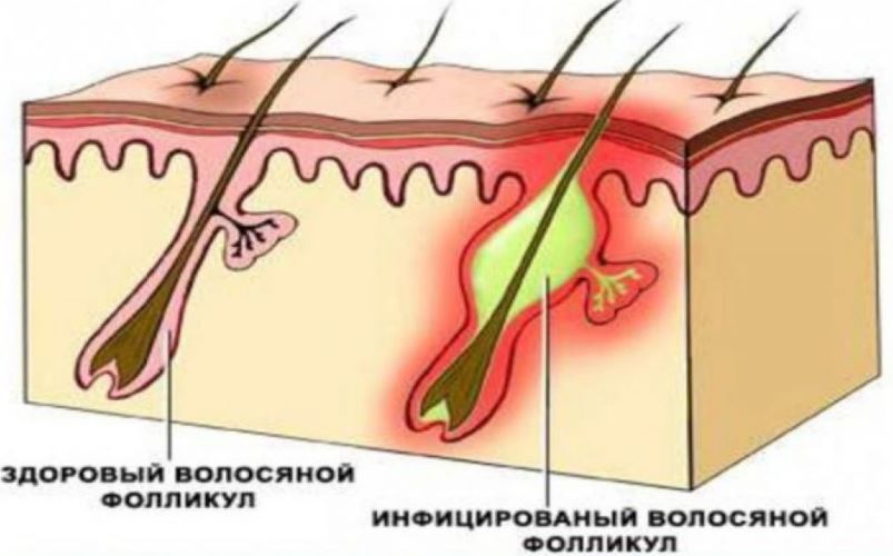 Электроэпиляция без уколов